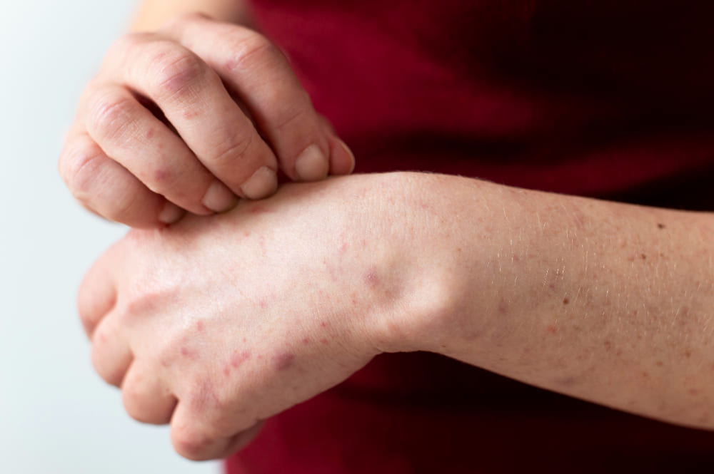 What is scabies, symptoms of scabies
