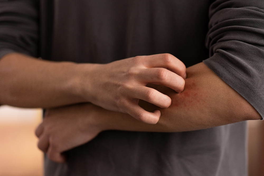 Symptoms of scabies